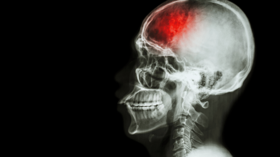 CTA-Based Screening Reduces Time to Diagnosis and Stroke Rate in Blunt Cervical Vascular Injury